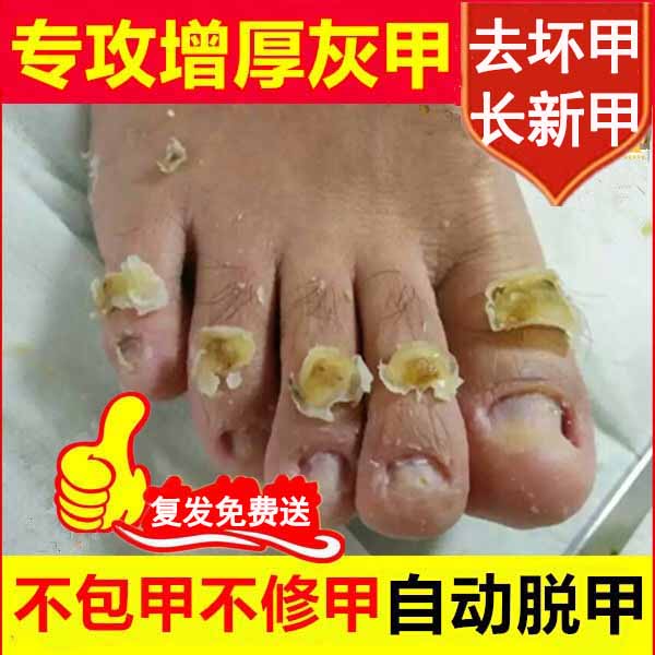 2瓶装趾甲无痛去除增厚发黄手足