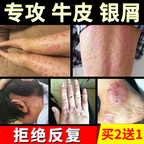 银屑藓全身头皮癣药膏正品手脚皮肤瘙痒外用药老偏方杀菌止痒抑菌