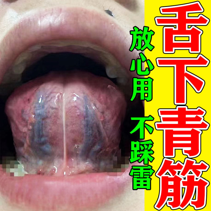 舌下青筋又黑又粗大淤血舌底紫血管严重疏通怒张口腔溶栓液喷剂药