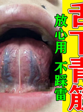 舌下青筋又黑又粗大淤血舌底紫血管严重疏通怒张口腔溶栓液喷剂药