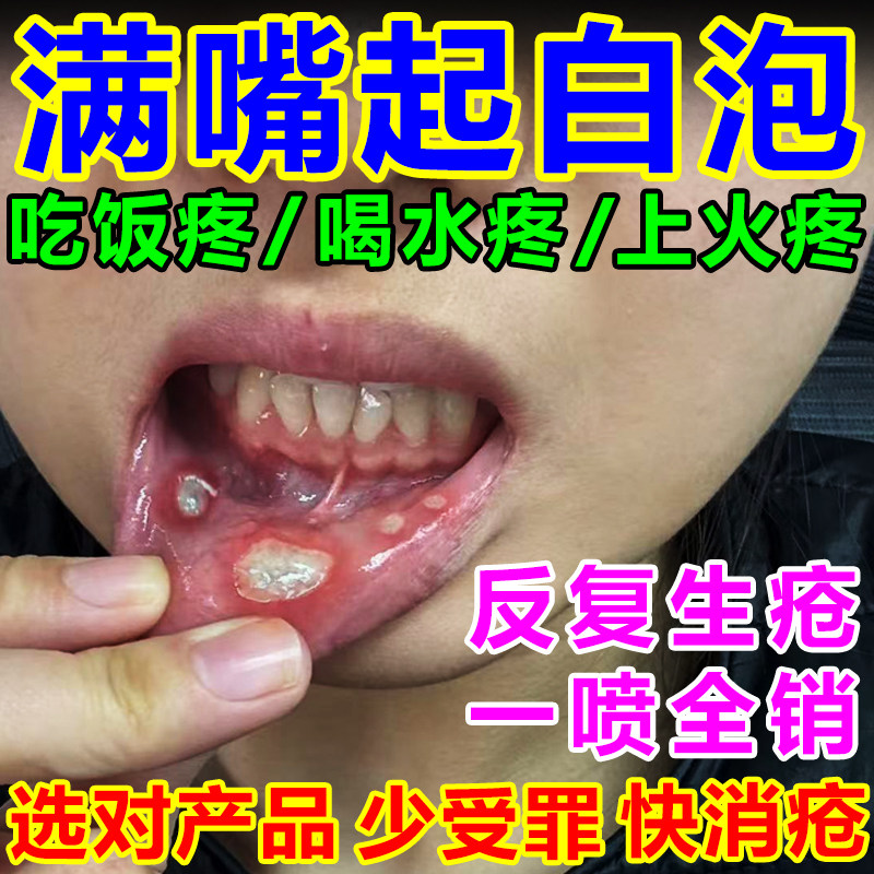 口腔上火口疮疼痛修复喷剂