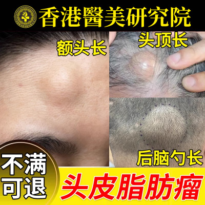 头上长硬疙瘩皮下脂肪瘤神专用器消瘤膏硬块后脑勺额头鼓包去B6