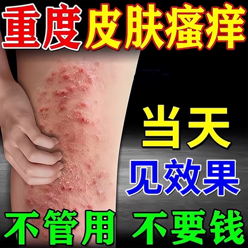 日本顽固皮肤湿疹止痒外用皮炎阴囊肛周去湿痒根干燥痒抑菌软药膏