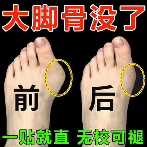 速发拇指外早【贴用翻好】拇指外翻肌肉贴大脚趾重叠关节肿大药膏