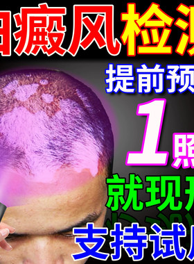 白癜风检测灯面部皮肤白斑家用鉴定仪医院同款荧光真菌紫光伍德灯