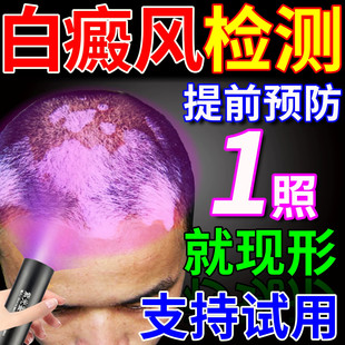 白癜风检测灯面部皮肤白斑家用鉴定仪医院同款 荧光真菌紫光伍德灯