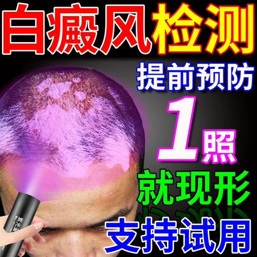 白癜风检测灯面部皮肤白斑家用鉴定仪医院同款荧光真菌紫光伍德灯