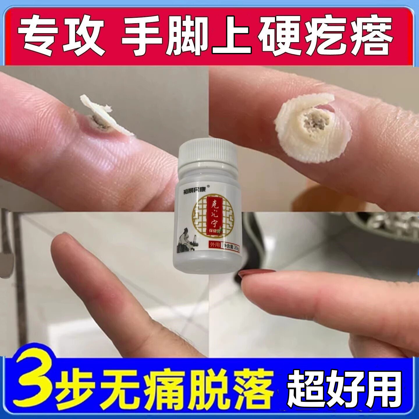 拔脚上硬疙瘩点小肉刺痦子痣专用膏连根手上脚上长刺鱼鳞去除神器
