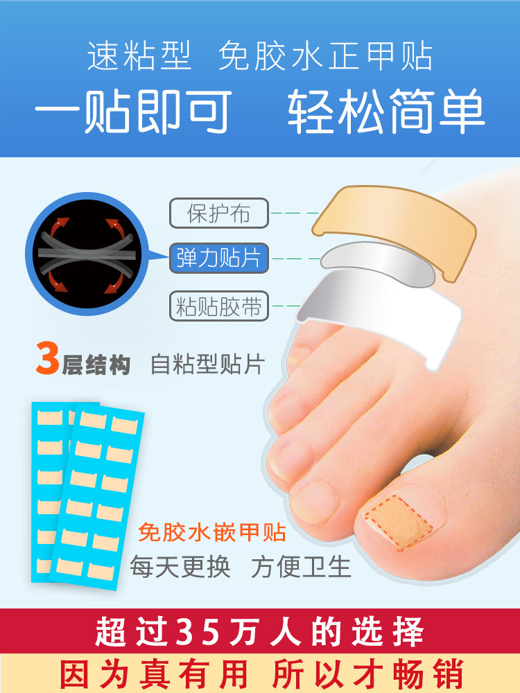 손톱 홈 교정 패치 내생발톱 패치 손톱 버클 발톱 패치 긴살 인공물 손톱 컬 염증 복구 및 교정