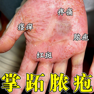 掌趾脓疱病症专用药治疗手脚脓包角化病手足疱干裂掌跖脓疱专用药