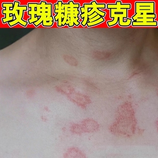 玫瑰糠疹外用膏湿痒成人儿童换季皮肤过敏发痒花斑痒外用修复软膏