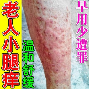 身上痒的药治老年人皮肤发痒秋冬小腿皮肤干燥腿上红疙瘩过敏乳膏