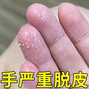 治疗手脱皮的药膏手指上起皮干燥脚粗糙掉皮足底真菌感染皮肤裂开