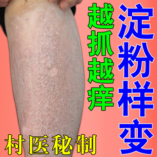 皮肤淀粉样变外用膏治疗顽固皮痒粗糙小腿后背粗糙颗粒肤痒修复膏