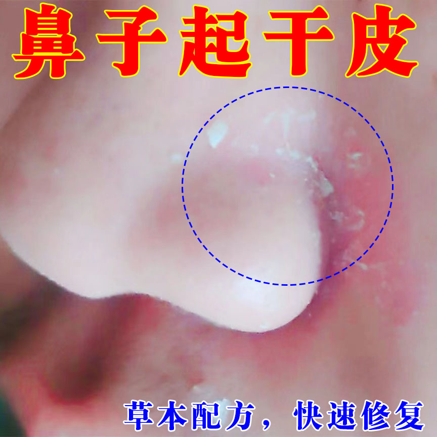 鼻子两侧起干皮发红脱皮专用膏
