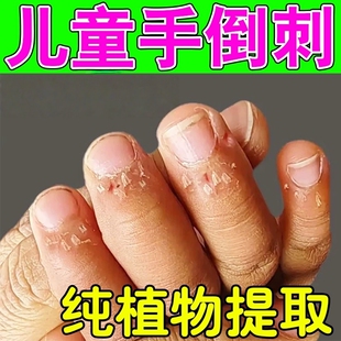 儿童手指起倒刺修复小孩子宝宝手上干裂脱皮长肉刺疼痛滋润护手霜