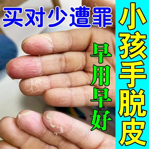 小孩手脱皮严重脱皮专用季节性手掌手指蜕皮干裂剥脱性角质松懈症