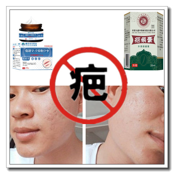 祛男女增生性凹凸巴消除手术烟烫烧伤疙瘩药淡化黑色素沉着疤痕印