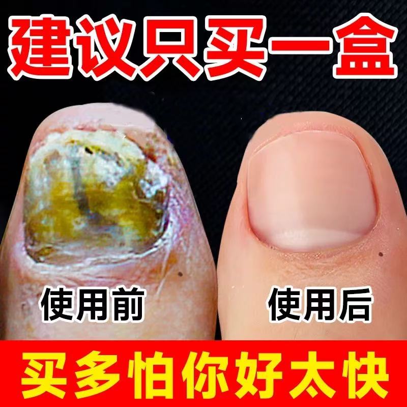 阿莫罗芬搽剂灰指甲修复液脱甲膏去除增厚药水正品官方旗舰店