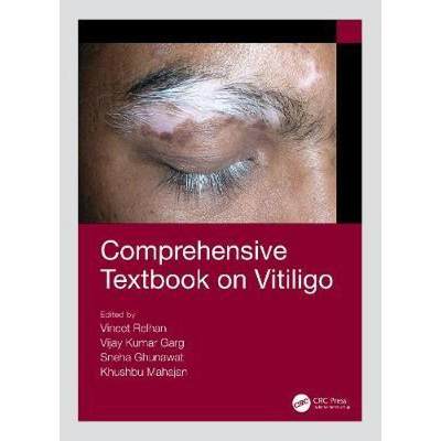 【4周达】COMPREHENSIVE TEXTBOOK ON VITILIGO, [9781138063594]