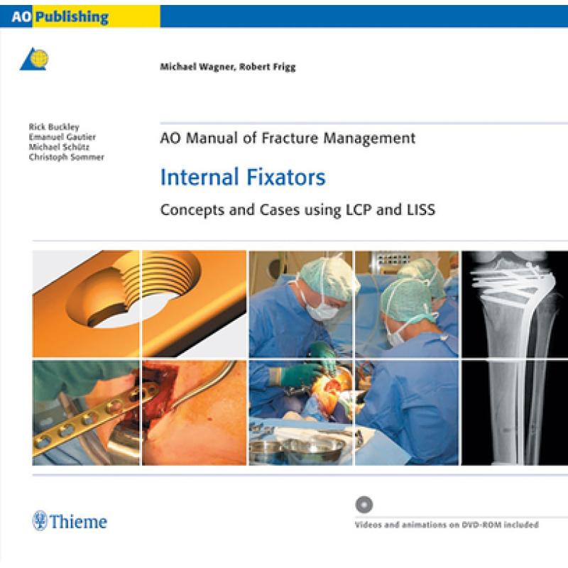 【4周达】AO Manual of Fracture Management - Internal Fixators: Concepts and Cases Using LCP/LISS [9783131435514] 书籍/杂志/报纸 科学技术类原版书 原图主图