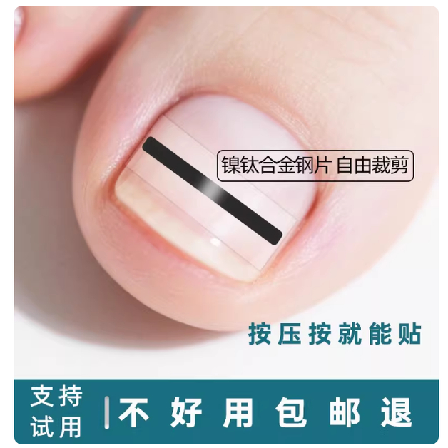 镍钛合金嵌甲矫正器正甲贴