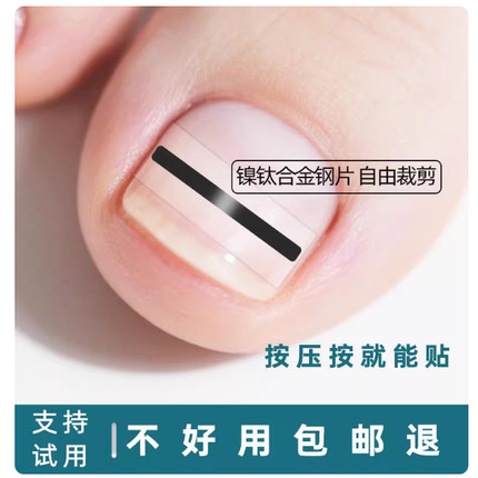 镍钛合金嵌甲矫正器正甲贴片指甲扎肉纠正扣大脚趾甲拉拉炎隔离贴