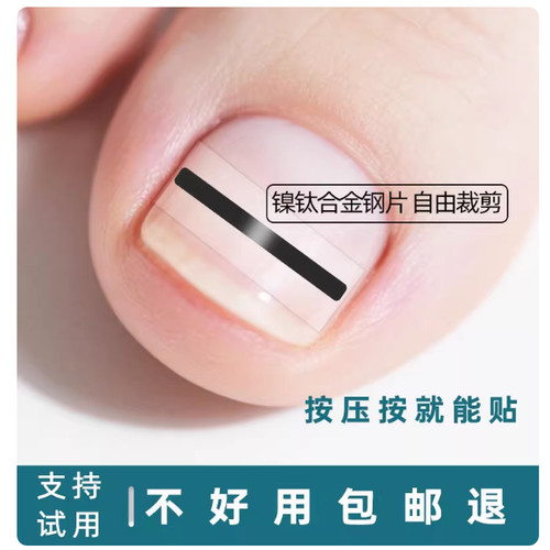 镍钛合金嵌甲矫正器正甲贴
