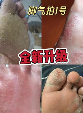 买一送一云南本草喷剂烂脚丫糜烂去止痒脱皮杀菌真菌感染专用神器