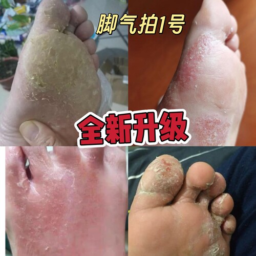 买一送一云南本草喷剂烂脚丫糜烂去止痒脱皮杀菌真菌感染专用神器
