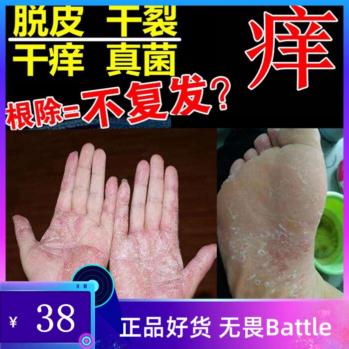 脚底蜕皮抑菌止痒乳膏