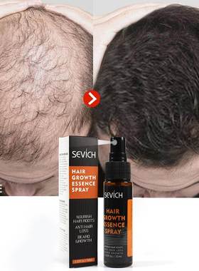 Sevich Hair Growth Spray Serum Ginger Anti Hair Loss Fast Gr