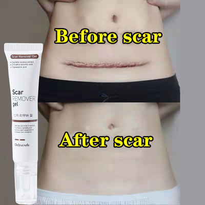 Acne Scar Removal Cream Repair Maternity Stretch Marks Gel R