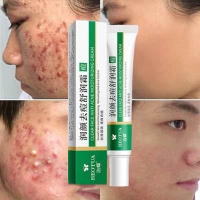 Effective Acne Removal Cream Treatment Acne Scar Spots Cream