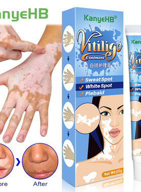 20g Herbal Extract Vitiligo Ointment Remove Ringworm White S