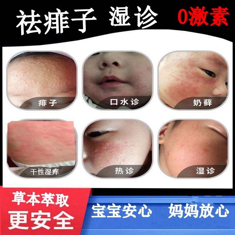 婴儿痱子膏霜宝宝湿红疹热痱婴幼保健理疗