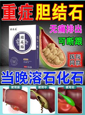 治疗胆结石溶石化石排石特效专用药进口金钱草胆囊结石清石中药贴