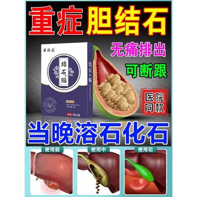 治疗胆结石溶石化石排石特效专用药进口金钱草胆囊结石清石中药贴