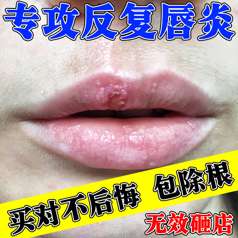 唇炎膏药贴唇膏烂嘴角开裂口角炎儿童干裂脱皮嘴唇疱疹溃疡专用药
