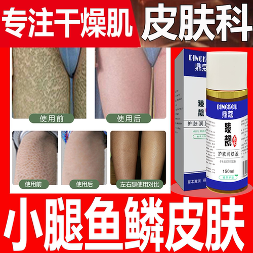 小腿干燥鳞屑肌肤鼎蔻身体乳液