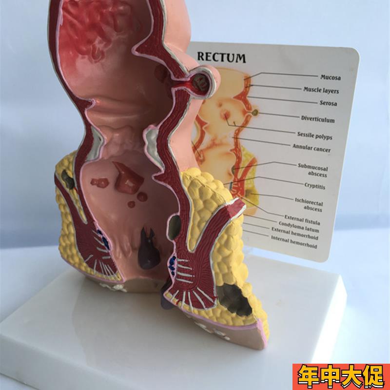 人体肛肠病理模型直肠科痔疮肛瘘裂隙病变模型医学肛肠科直肠模型