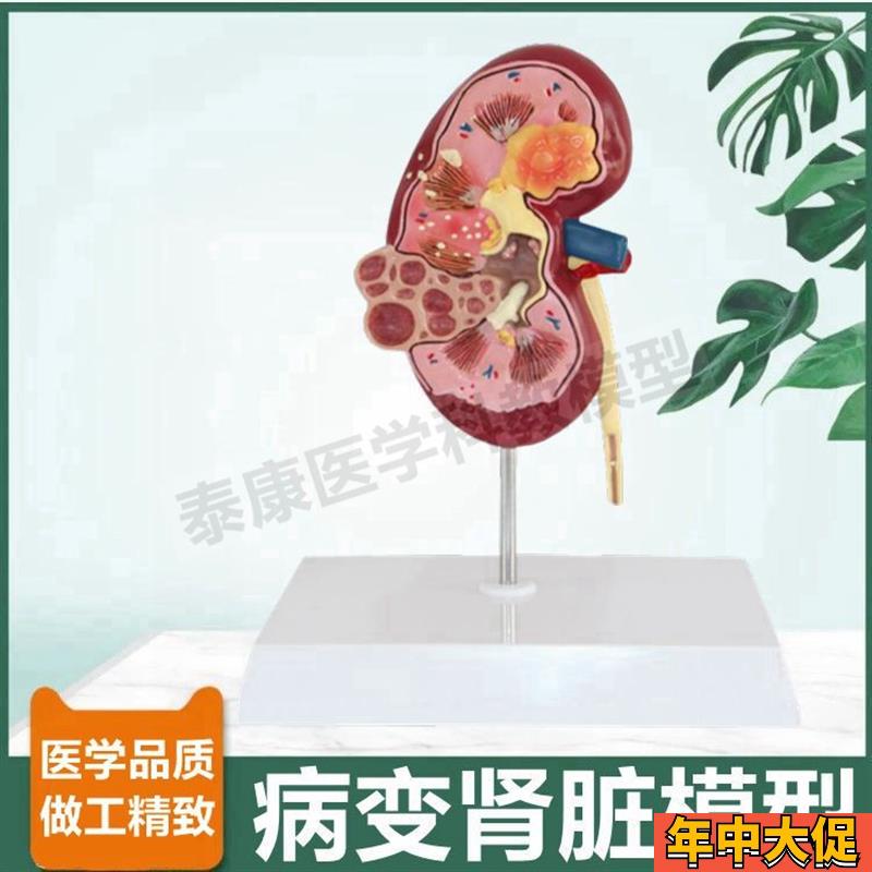 人病理肾脏模型泌尿系统蛋白尿肾小球肾单位尿液肾上腺内分泌腺体