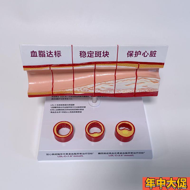 病理心血管模型粥样硬化脂肪斑块动脉内膜受损程度医药促销礼品