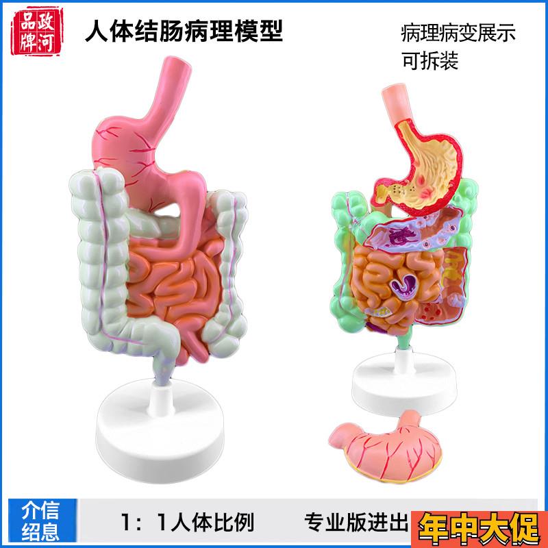 政河结肠病理演示人体器官结构解剖模型十二指肠胃系统内脏构造