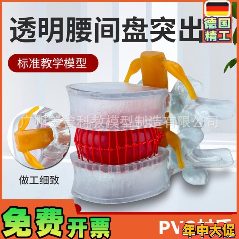 腰椎放大 腰椎间盘模型 挤压突出演示 脊柱 脊椎骨病理演示模型