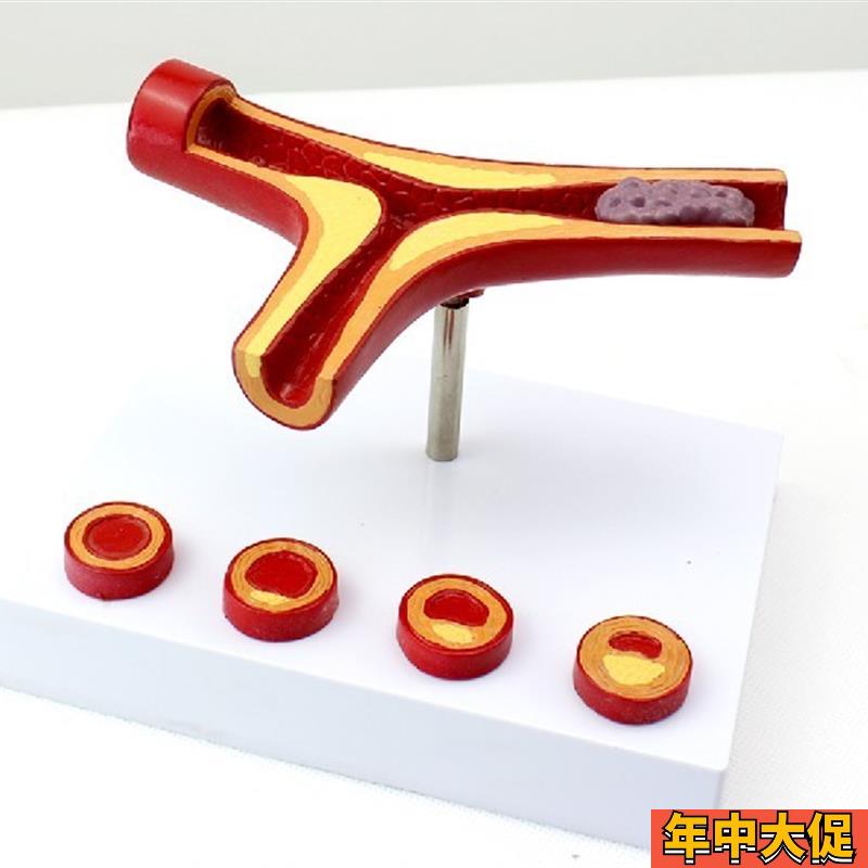 颐诺正品冠状动脉性心血管动脉硬化模型老年心脏模型血栓形成