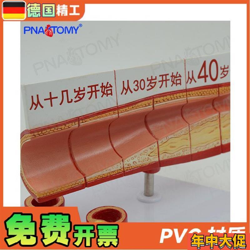 德国】人体动脉血管堵塞模型心脑血管血栓/硬化模型 教学心脑血管