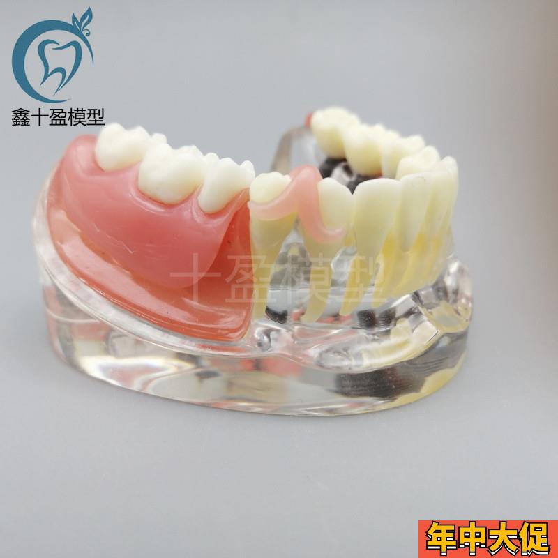 牙科口腔教学 种植与修复模型 3颗钉模型 微型种植 医患沟通M6006