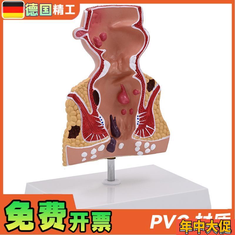 德国】新款大促爆款人体模型肠直肠解剖病理模型病态疾病教具模具