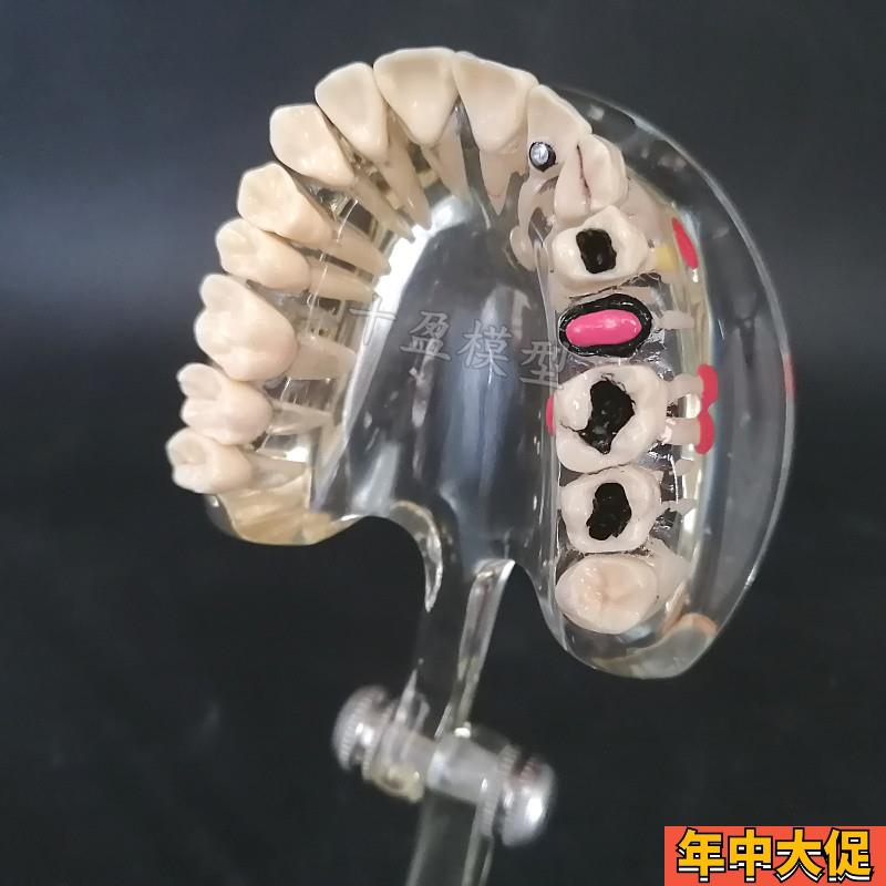 牙科牙齿模型 成人病理半侧可拔牙模型医患沟通口腔教学教具 C3
